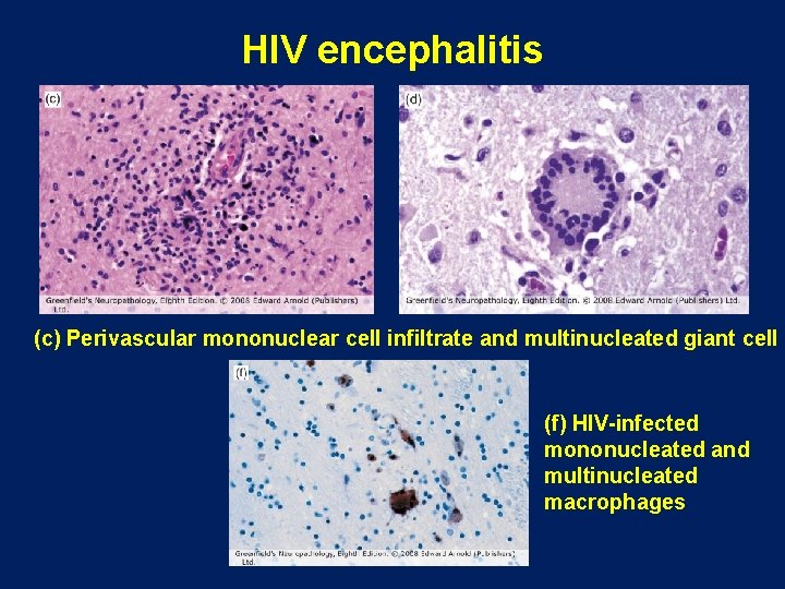 HIV encephalitis (c) Perivascular mononuclear cell infiltrate and multinucleated giant cell (f) HIV-infected mononucleated HIV encephalitis (c) Perivascular mononuclear cell infiltrate and multinucleated giant cell (f) HIV-infected mononucleated
