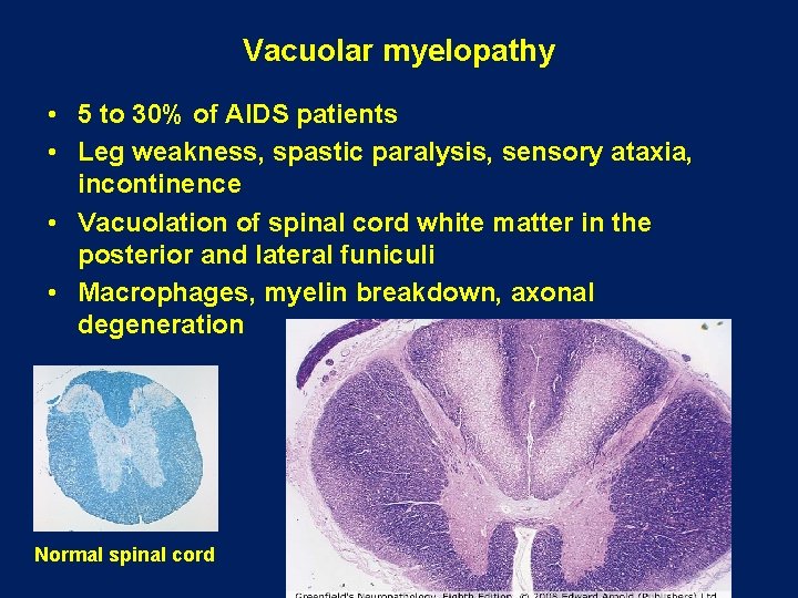 Vacuolar myelopathy • 5 to 30% of AIDS patients • Leg weakness, spastic paralysis, Vacuolar myelopathy • 5 to 30% of AIDS patients • Leg weakness, spastic paralysis,