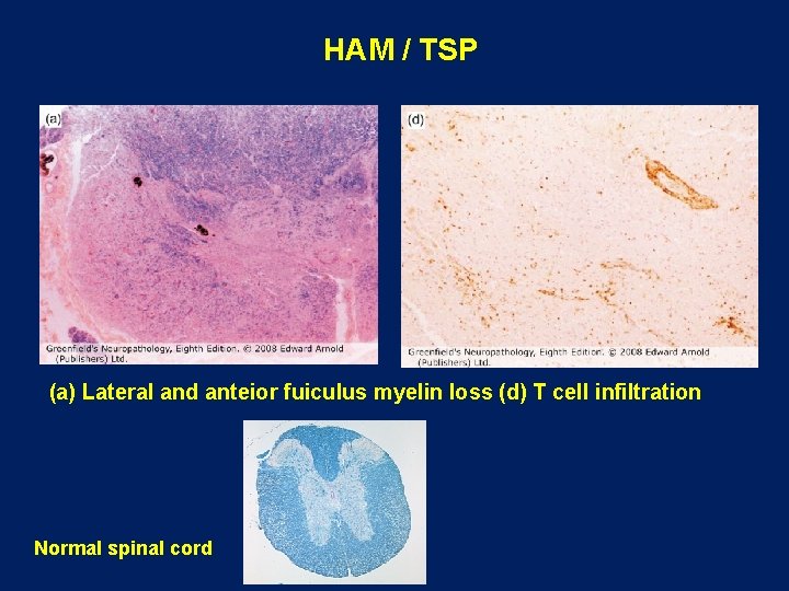 HAM / TSP (a) Lateral and anteior fuiculus myelin loss (d) T cell infiltration HAM / TSP (a) Lateral and anteior fuiculus myelin loss (d) T cell infiltration