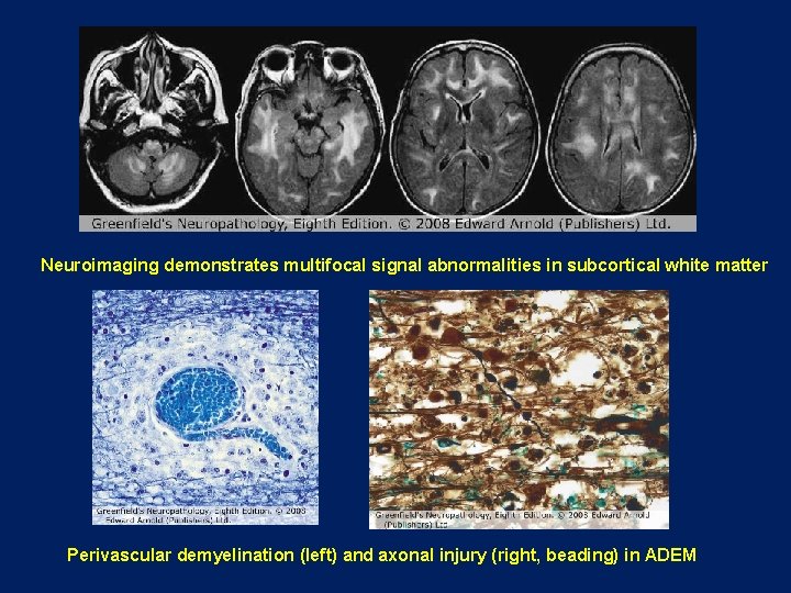 Neuroimaging demonstrates multifocal signal abnormalities in subcortical white matter Perivascular demyelination (left) and axonal Neuroimaging demonstrates multifocal signal abnormalities in subcortical white matter Perivascular demyelination (left) and axonal