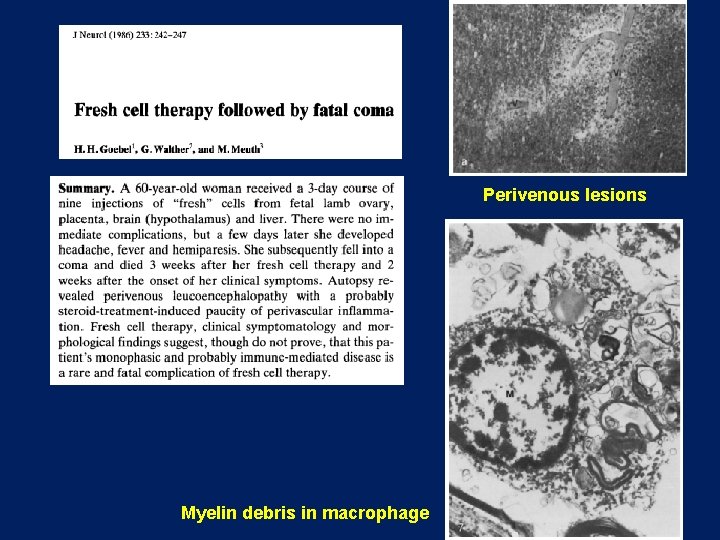 Perivenous lesions Myelin debris in macrophage Perivenous lesions Myelin debris in macrophage