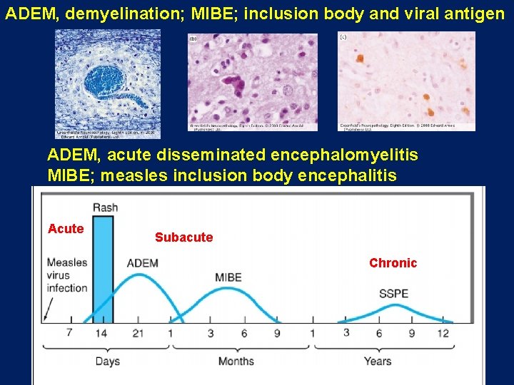ADEM, demyelination; MIBE; inclusion body and viral antigen ADEM, acute disseminated encephalomyelitis MIBE; measles ADEM, demyelination; MIBE; inclusion body and viral antigen ADEM, acute disseminated encephalomyelitis MIBE; measles