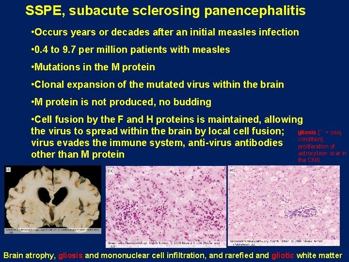 SSPE, subacute sclerosing panencephalitis • Occurs years or decades after an initial measles infection SSPE, subacute sclerosing panencephalitis • Occurs years or decades after an initial measles infection