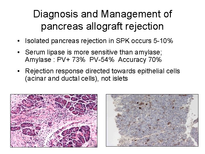 Diagnosis and Management of pancreas allograft rejection • Isolated pancreas rejection in SPK occurs