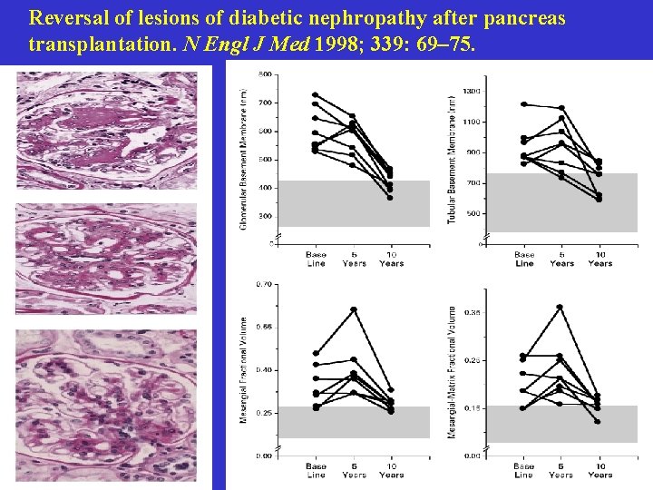 Reversal of lesions of diabetic nephropathy after pancreas transplantation. N Engl J Med 1998;