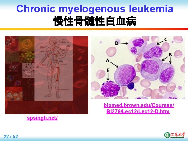 Chronic myelogenous leukemia 慢性骨髓性白血病 biomed. brown. edu/Courses/ BI 279/Lec 12 -D. htm spsingh. net/