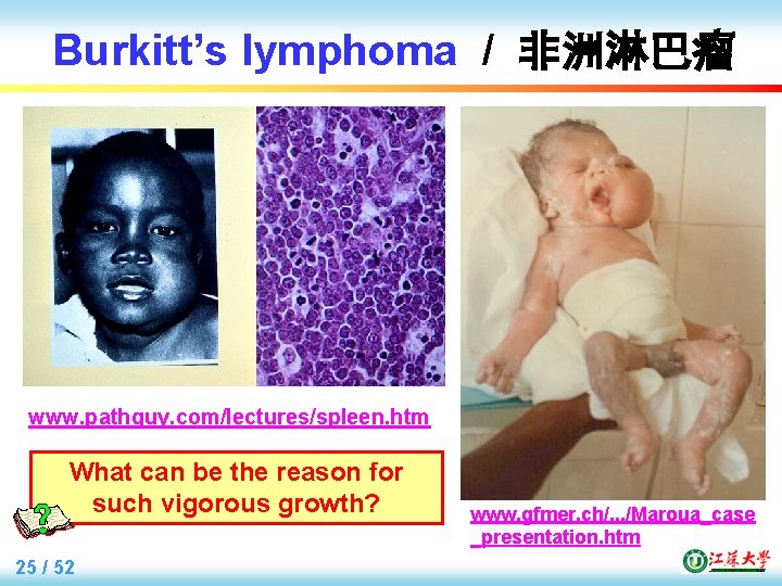 Burkitt’s lymphoma / 非洲淋巴瘤 www. pathguy. com/lectures/spleen. htm What can be the reason for