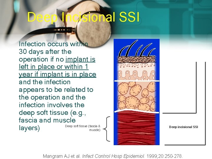 Deep Incisional SSI Infection occurs within 30 days after the operation if no implant