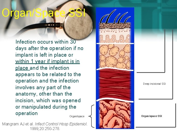 Organ/Space SSI Infection occurs within 30 days after the operation if no implant is