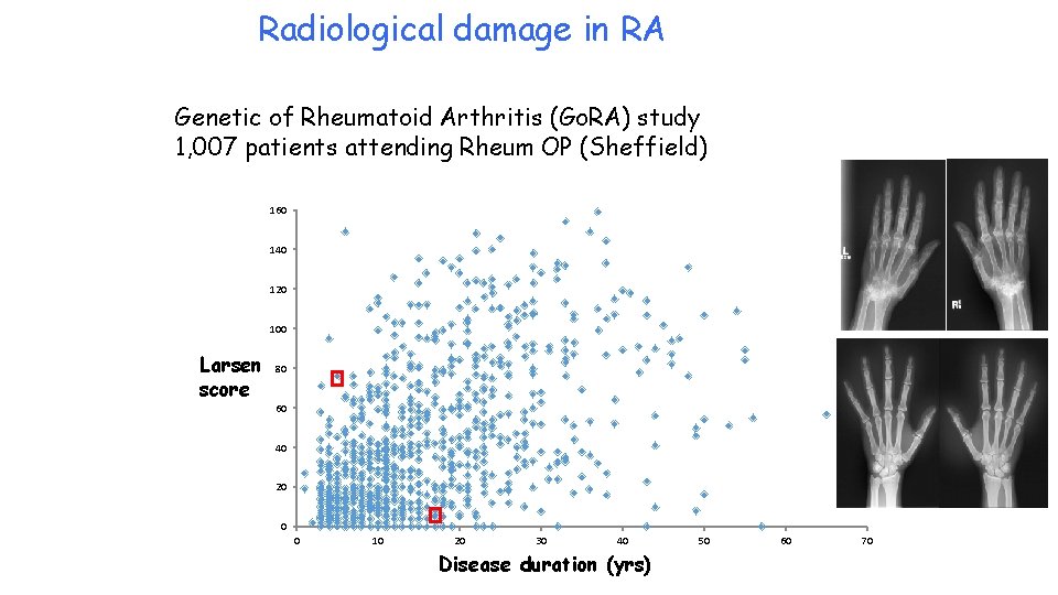 Radiological damage in RA Genetic of Rheumatoid Arthritis (Go. RA) study 1, 007 patients