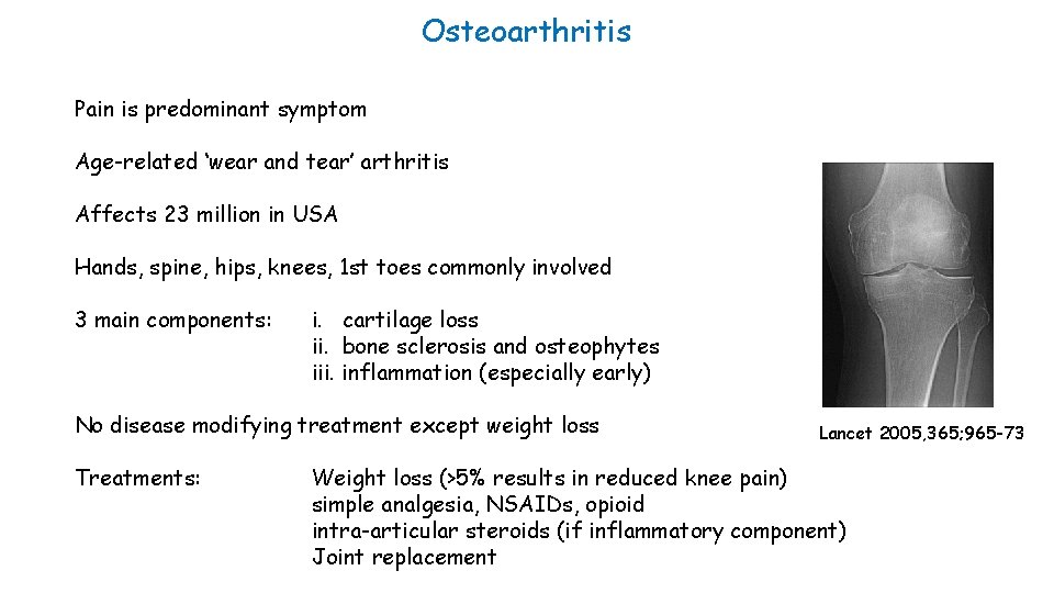 Osteoarthritis Pain is predominant symptom Age-related ‘wear and tear’ arthritis Affects 23 million in