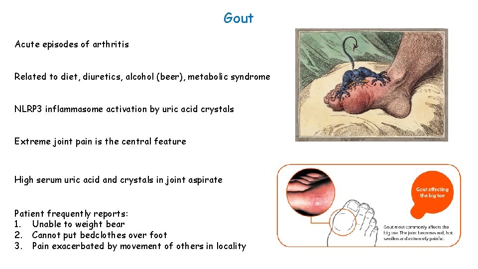 Gout Acute episodes of arthritis Related to diet, diuretics, alcohol (beer), metabolic syndrome NLRP