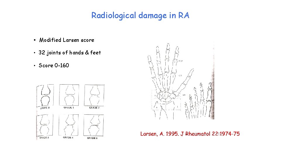 Radiological damage in RA • Modified Larsen score • 32 joints of hands &