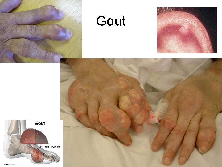 Gout 