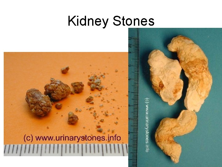 Kidney Stones 