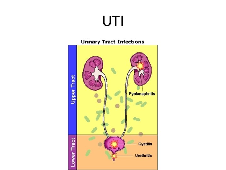 UTI 