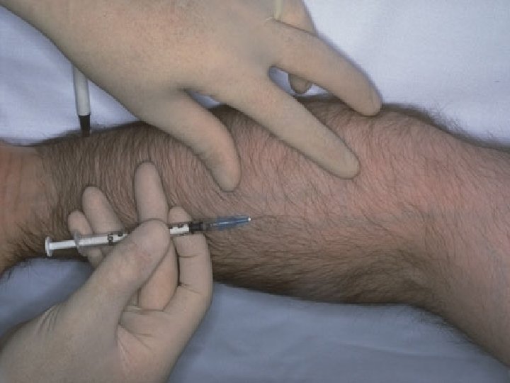 Ejemplo típico hipersensibilidad retardada: Test de Mantoux. Previa asepsia de la piel, se inyecta