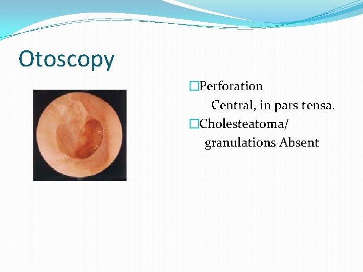 Otoscopy �Perforation Central, in pars tensa. �Cholesteatoma/ granulations Absent 