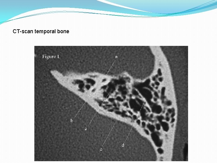 CT-scan temporal bone 