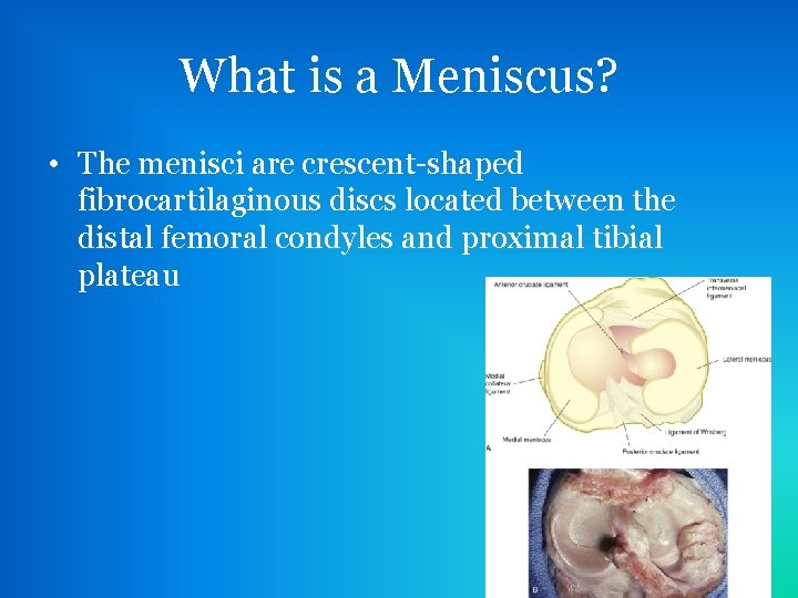 What is a Meniscus? • The menisci are crescent-shaped fibrocartilaginous discs located between the