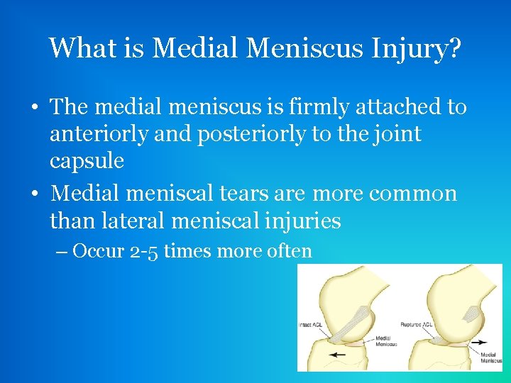 What is Medial Meniscus Injury? • The medial meniscus is firmly attached to anteriorly