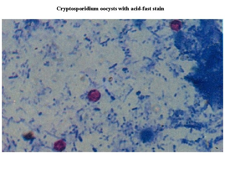 Cryptosporidium oocysts with acid-fast stain 