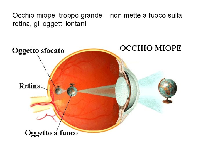 Occhio miope troppo grande: non mette a fuoco sulla retina, gli oggetti lontani 