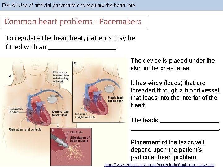 D. 4. A 1 Use of artificial pacemakers to regulate the heart rate. Common