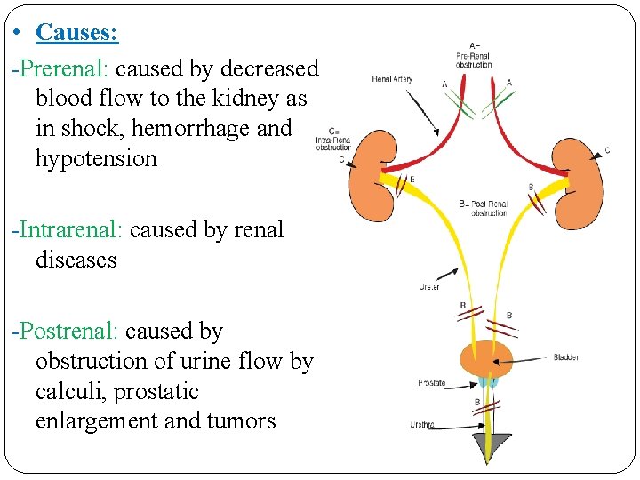  • Causes: -Prerenal: caused by decreased blood flow to the kidney as in