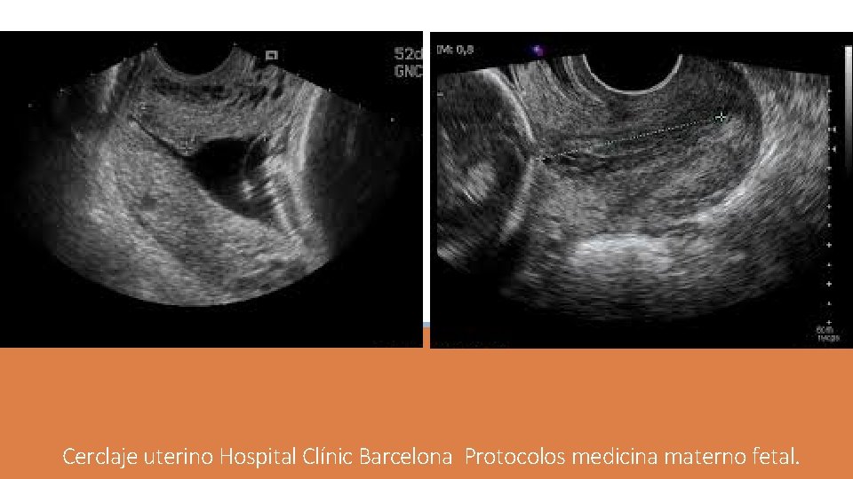 Cerclaje uterino Hospital Clínic Barcelona Protocolos medicina materno fetal. Cerclaje uterino Hospital Clínic Barcelona Protocolos medicina materno fetal.