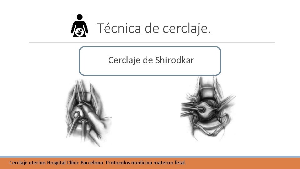 Técnica de cerclaje. Cerclaje de Shirodkar Cerclaje uterino Hospital Clínic Barcelona Protocolos medicina materno Técnica de cerclaje. Cerclaje de Shirodkar Cerclaje uterino Hospital Clínic Barcelona Protocolos medicina materno