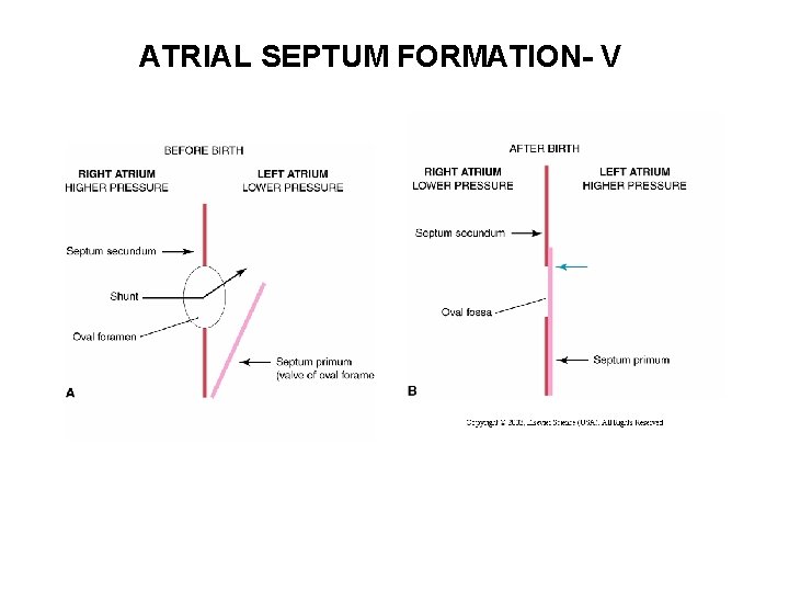 ATRIAL SEPTUM FORMATION- V 