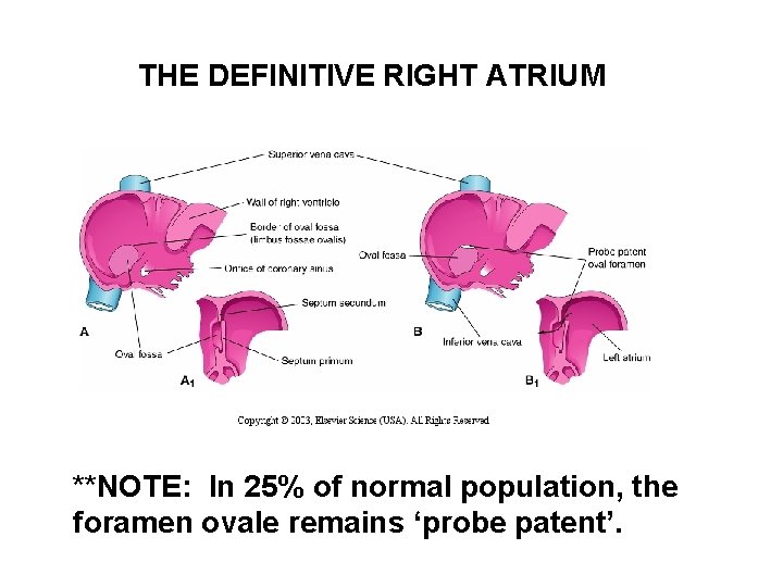 THE DEFINITIVE RIGHT ATRIUM **NOTE: In 25% of normal population, the foramen ovale remains