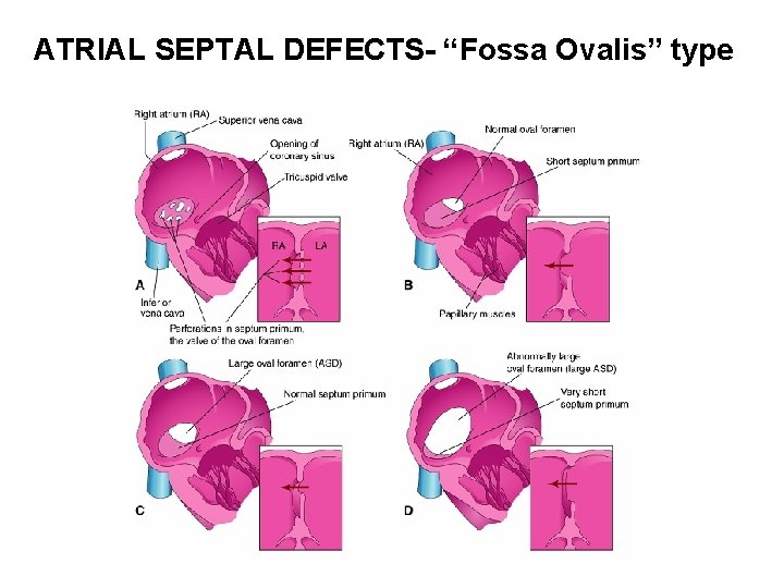 ATRIAL SEPTAL DEFECTS- “Fossa Ovalis” type 