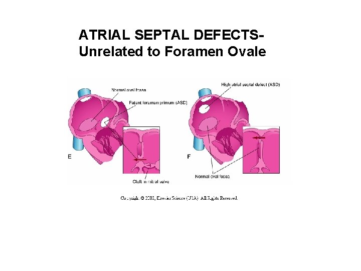 ATRIAL SEPTAL DEFECTSUnrelated to Foramen Ovale 