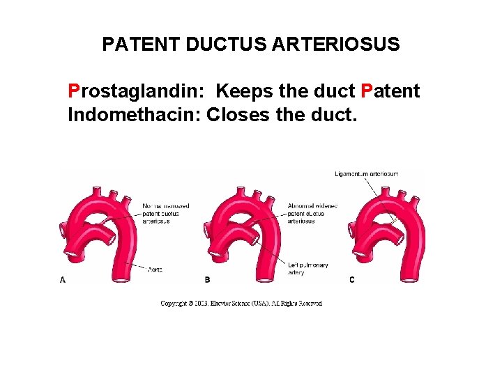 PATENT DUCTUS ARTERIOSUS Prostaglandin: Keeps the duct Patent Indomethacin: Closes the duct. 