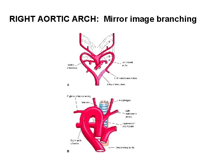 RIGHT AORTIC ARCH: Mirror image branching 