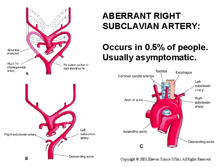 ABERRANT RIGHT SUBCLAVIAN ARTERY: Occurs in 0. 5% of people. Usually asymptomatic. 