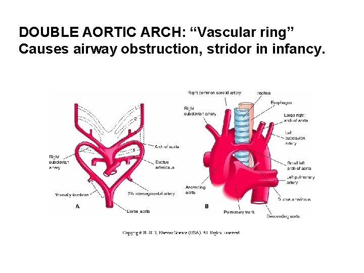 DOUBLE AORTIC ARCH: “Vascular ring” Causes airway obstruction, stridor in infancy. 