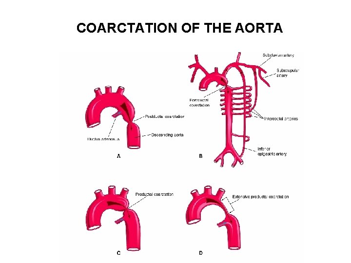 COARCTATION OF THE AORTA 