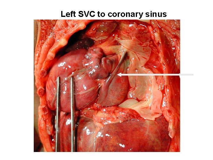 Left SVC to coronary sinus 