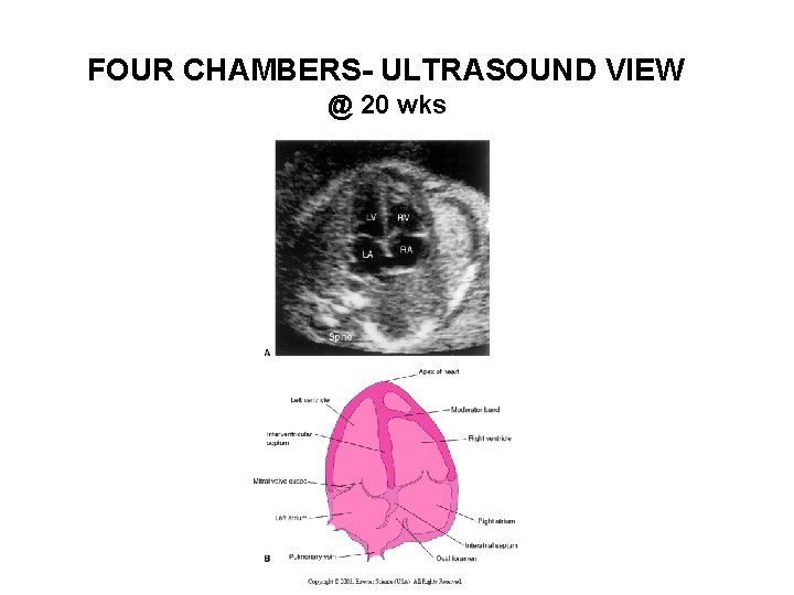 FOUR CHAMBERS- ULTRASOUND VIEW @ 20 wks 