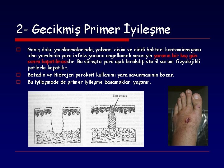 2 - Gecikmiş Primer İyileşme o o o Geniş doku yaralanmalarında, yabancı cisim ve