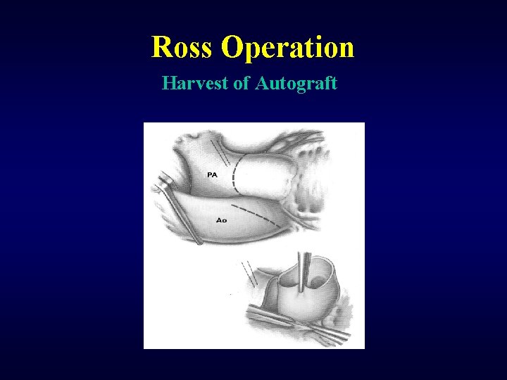 Ross Operation Harvest of Autograft 