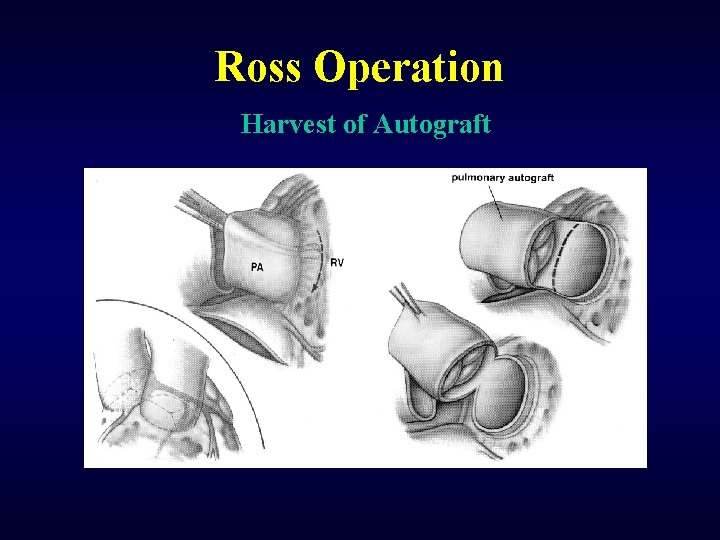 Ross Operation Harvest of Autograft 