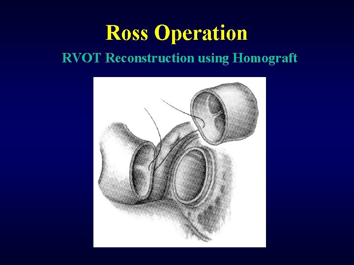 Ross Operation RVOT Reconstruction using Homograft 