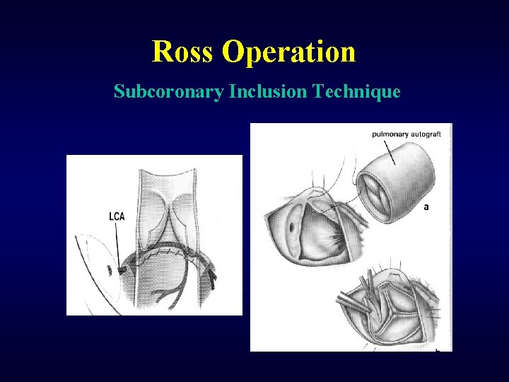 Ross Operation Subcoronary Inclusion Technique 
