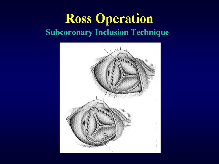 Ross Operation Subcoronary Inclusion Technique 