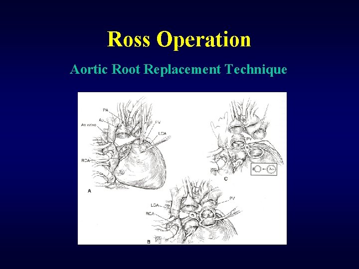 Ross Operation Aortic Root Replacement Technique 