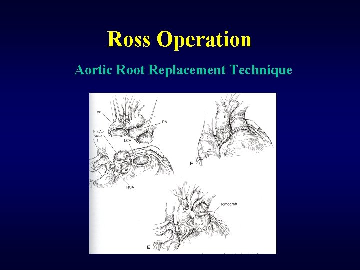 Ross Operation Aortic Root Replacement Technique 